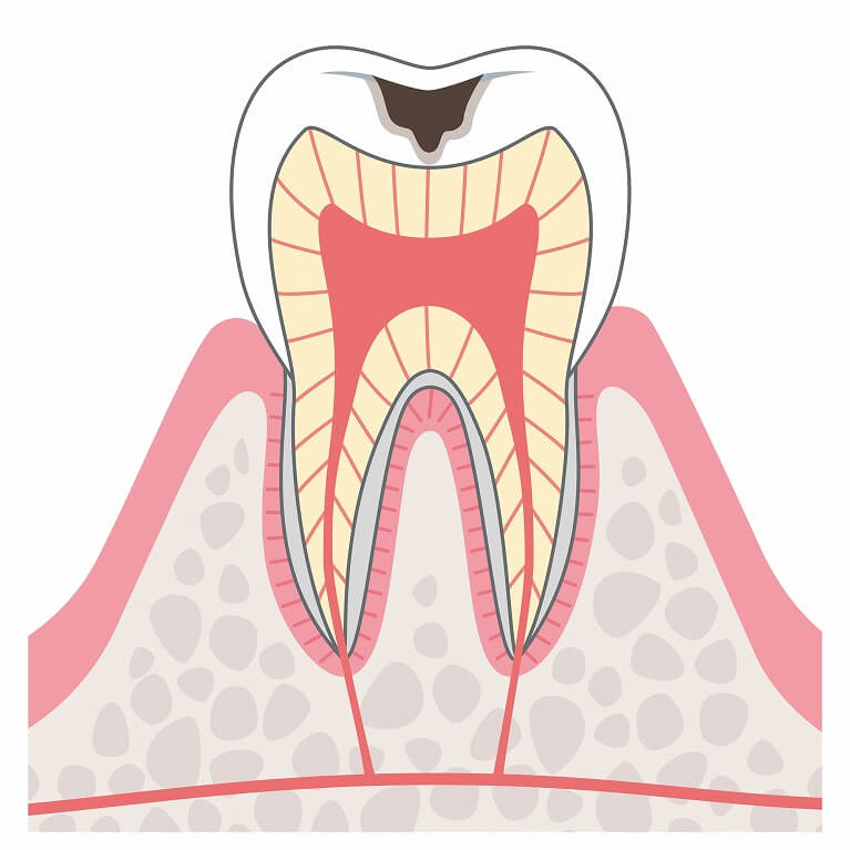 C2　象牙質のむし歯