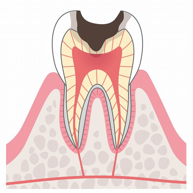C3　歯の神経のむし歯