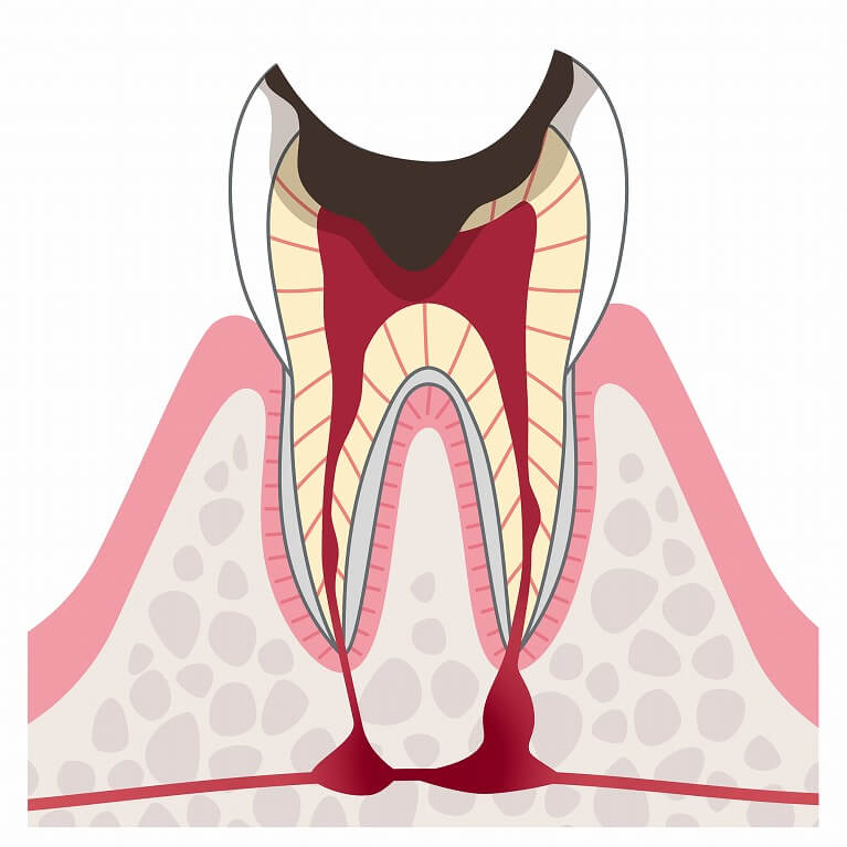 C4　歯の根のむし歯