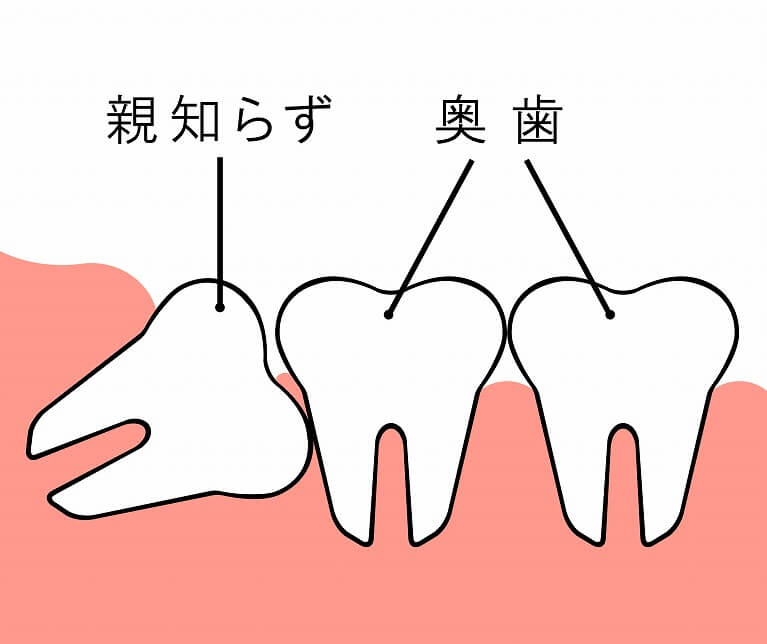 親知らずの抜歯について